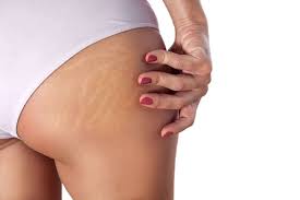 ozonoterapia celulitis
